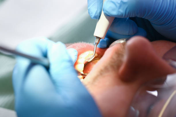 Best Knocked-Out Tooth (Avulsed Tooth) Treatment in San Antonio, FL